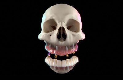 Dinți ficși în 24 de ore: alternativa la protezele mobile