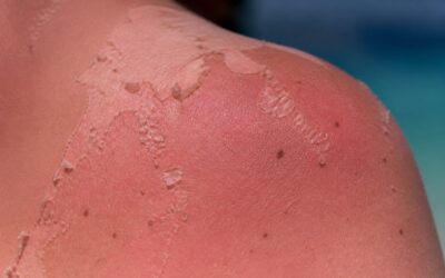 Cinci arsuri solare pot dubla riscul de melanom spun medicii
