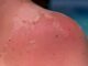 Cinci arsuri solare pot dubla riscul de melanom spun medicii