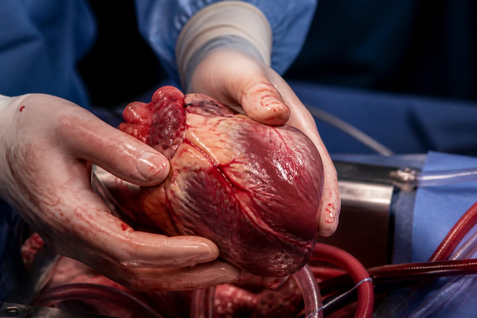 Primul transplant de inimă realizat la Institutul de Boli Cardiovasculare din Iași a salvat un pacient de 44 de ani